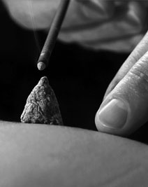 Acupuncture treatment