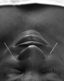 Facial Acupuncture